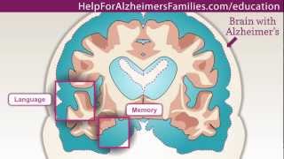 Alzheimers Effect on the Brain [upl. by Rihat]