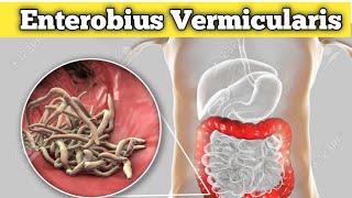 Enterobius vermicularis Habitat life cycle and pathogenicity etc [upl. by Sanfourd]