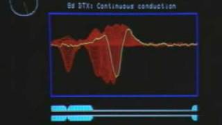 Conduction in demyelinated axon [upl. by Adekahs]