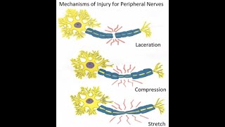 Peripheral nerve injuries classification and Wallerian degeneration [upl. by Ailekat]