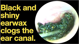 Black and shiny earwax clogs the ear canalear wax removal  ear cleaning  ASMR  relaxation [upl. by Ramyaj]