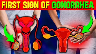 First Sign Of Gonorrhoea Danger How You Will Feel When You Have Gonorrhoea [upl. by Durwin]