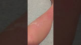 Skin Peeling from Sunburn asmr [upl. by Groos]