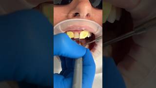 Composite bonding makeover short dentist royalsahu21 [upl. by Ahsiuqal]