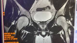 Pinzamiento femoroacetabular [upl. by Ahsercul]