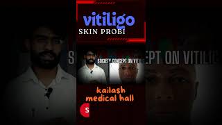 Vitiligo fact Nepali 2024 [upl. by Kailey]