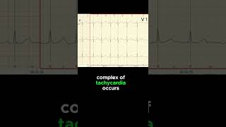 FOCAL ATRIAL TACHYCARDIA ECG EXAMPLE [upl. by Bechler]