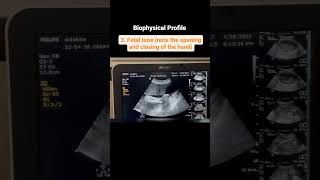 Components of a Biophysical Profile [upl. by Kirshbaum807]