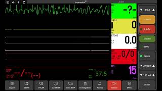 Pulseless Electrical Activity PEA [upl. by Hartmann]