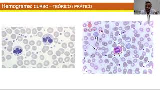 CURSO DE INTERPRETAÇÃO DE HEMOGRAMA  PARTE 03 PLAQUETOGRAMA [upl. by Nnasus]