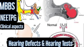 Hearing Defects amp Hearing Tests Rinnes test Webers test Schwabachs test mbbs neetpg [upl. by Gnart]