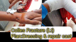 Colles Fracture LtPlanDressing amp repair castOur Treatment [upl. by Alacim]