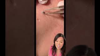 Some great blackheads and DPOWs on the back [upl. by Casteel]