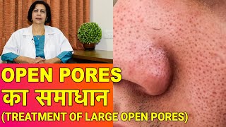 ओपन पोर्स का ईलाज  Open Pores Treatment [upl. by Lowell35]