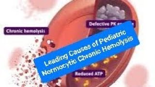 Leading Causes of Pediatric Normocytic Chronic Hemolysis G6PD and PKD [upl. by Galven]