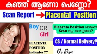 Gender Prediction Malayalam Anterior Placental Boy Girl കുഞ്ഞ് ആണോ പെണ്ണോ [upl. by Birdella52]