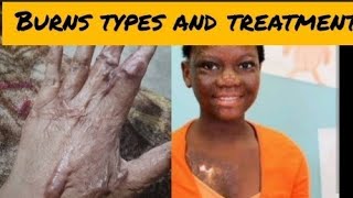 How to treat Burns at home by Dr AmaraBurns First Aid in HindiUrduBurns and its management [upl. by Eceinhoj]