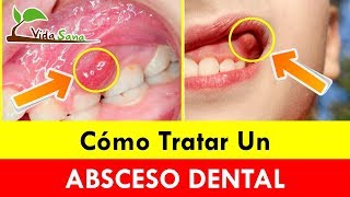 Como Tratar Un Absceso Dental Con Remedios Caseros Antes De Ir Al Dentista – Vida Sana [upl. by Stag]