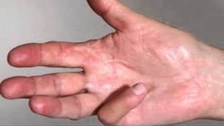 Straightening your fingers and Dupuytrens Contracture [upl. by Campball766]