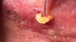 Super Satisfying Blackhead Removal from ear 2024 [upl. by Ahsinna79]