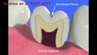 Como Prevenir la Caries Dental [upl. by Ashien]