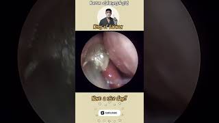 귀지형 콧물 부비동염 축농증 비염 코청소 이비인후과 rhinorrhea rhinitis sinusitis asmr ENT ENTdoctor [upl. by Nemracledairam]