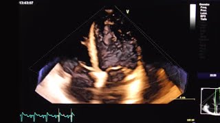 Left ventricular thrombus [upl. by Ardnoek803]