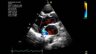 Echocardiographic assessment of the mitral valve [upl. by Cowie]