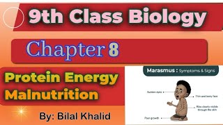 Protein Energy Malnutrition  Kwashiorkor amp Marasmus  Ch08  9th class Biology [upl. by Josephson421]