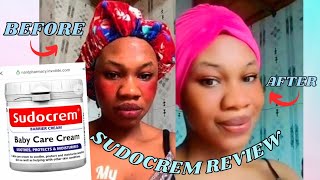 SUDOCREM it Removed my sunburn in4days😲acnetreatment sunburnremedytrending skincare viralvideo [upl. by Greenland]