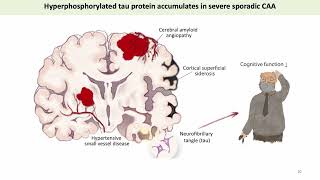 Cerebral Tau Pathology in Cerebral Amyloid Angiopathy [upl. by Anelrats279]