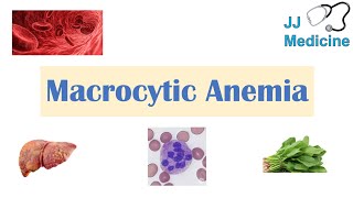 Macrocytic Anemia  Megaloblastic vs NonMegaloblastic  Approach amp Causes [upl. by Leyameg964]