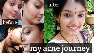 acne peel ചെയ്തപ്പോൾ എനിക്ക് സംഭവിച്ചത്acne journeymy experience acneproneskinitsmeaparna [upl. by Winikka351]