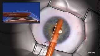 EndoSaver® Corneal Endothelium Delivery Instrument Instructional VideoJune 2012longmp4 [upl. by Sarajane3]