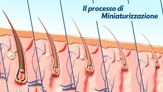 Alopecia Androgenetica il processo di Miniaturizzazione [upl. by Bluh]