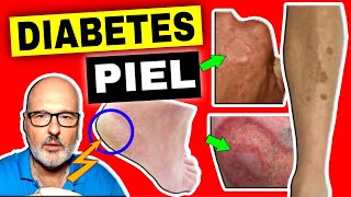 15 SIGNOS de DIABETES en la PIEL que no debes ignorar [upl. by Nnylak]