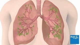 How chronic obstructive pulmonary disease COPD develops  Bupa Health [upl. by Elledoj]