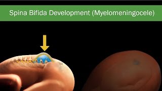 Fetal Spina Bifida Comprehensive Guide on Diagnosis Treatment amp Surgery [upl. by Llahsram]