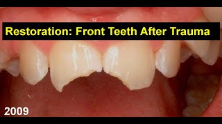 5 Min Case Restoration of Front Teeth after Trauma [upl. by Hakeber]