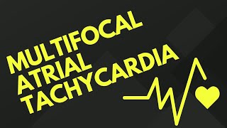 Multifocal Atrial Tachycardia ⏬👇 [upl. by Cirnek179]