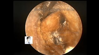 ear wax removing Severe cerumen embolism prosessing [upl. by Dor]