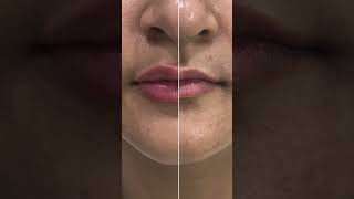 💋✨ Lip fillers skincare dermatologist skincareroutine [upl. by Ekalb734]