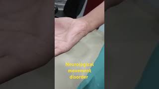 Neurological movement disorder shortvideo doctor viralshorts [upl. by Eidnyl]