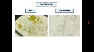 Stool Analysis 11 Undigested food [upl. by Elesig206]