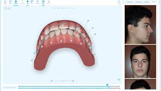 Quick Tip  Bite Correction Visualization in Aligners [upl. by Loredana760]