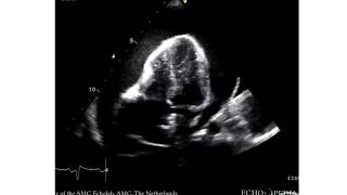 Tamponade amp Pericardiocentesis [upl. by Ynelram]