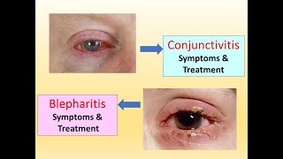 Blepharitis l Conjunctivitis l Spring Catarrh l symptoms amp Treatment l Eye Diseases Part 2 [upl. by Ellennej]