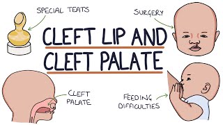 Cleft Lip and Cleft Palate For Students [upl. by Knepper]