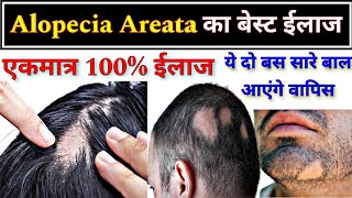 Alopecia Areata का बेस्ट ईलाज  Allopathic treatment of Alopecia Areata  Hair fall [upl. by Trini]