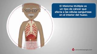 ¿Qué es el Mieloma Múltiple [upl. by Evangelia]